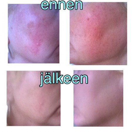 Ihon kunto ennen ja jälkeen kasvohoidon