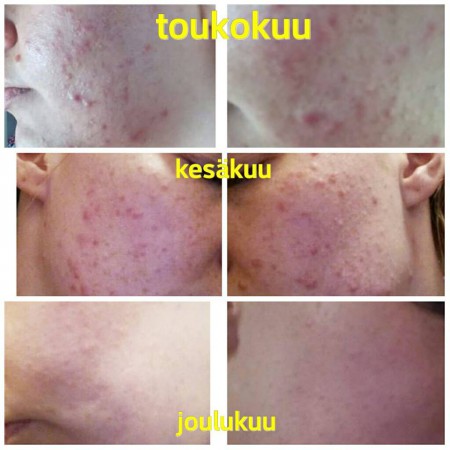 Asiakkaan kasvohoitotulos: ihon kunto toukokuusta joulukuuhun kasvohoitosarjan aikana